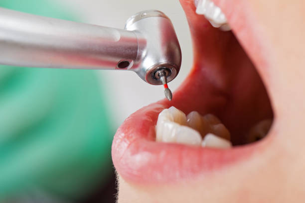 Best Emergency Root Canal Treatment in Oakhurst, CA